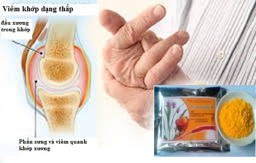 Chữa bệnh viêm khớp hiệu quả an tòan bằng tinh chất nghệ Curcumin Chữa bệnh viêm khớp hiệu quả an tòan bằng tinh chất nghệ Curcumin