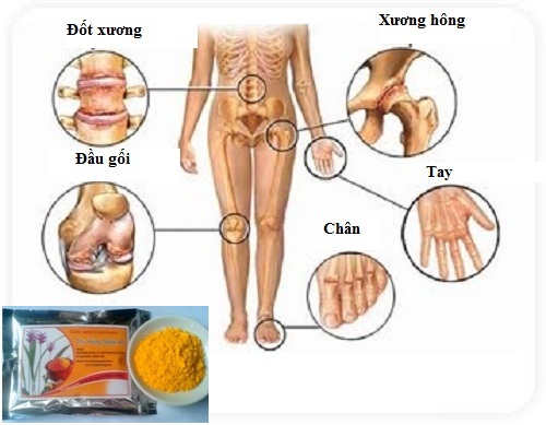 Tinh nghệ Curcumin - giải pháp điều trị viêm khớp hiệu quả nhất Tinh nghệ Curcumin - giải pháp điều trị viêm khớp hiệu quả nhất