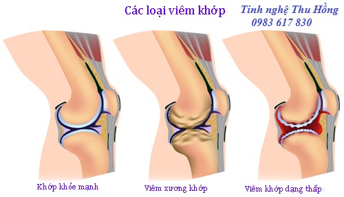 Tinh nghệ Curcumin niềm vui cho người bệnh viêm khớp Tinh nghệ Curcumin niềm vui cho người bệnh viêm khớp