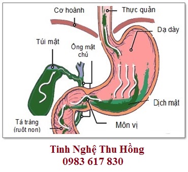 Tinh bột nghệ có tác dụng khi gặp rắc rối đường tiêu hoá