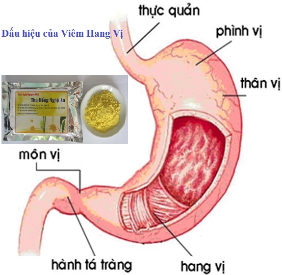Đau dạ dày cấp tính Đau dạ dày cấp tính