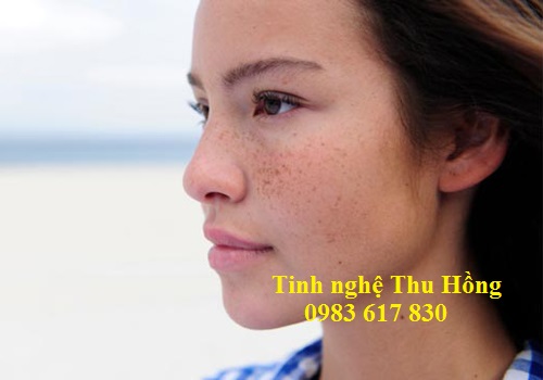 Nám da khiến chị em mất tự tin trong giao tiếp Nám da khiến chị em mất tự tin trong giao tiếp