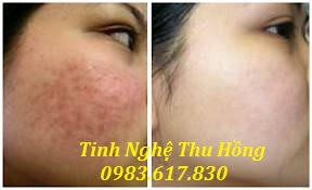 Tinh bột nghệ là sản phẩm điều trị tàn nhang hiệu quả Tinh bột nghệ điều trị tàn nhang hiệu quả