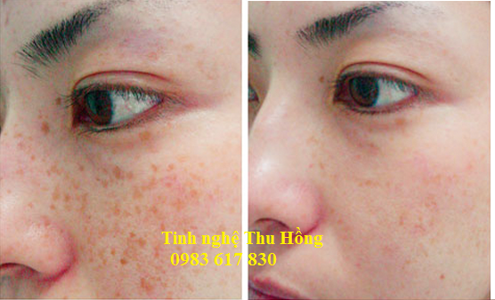 Trị nám da bằng tinh bột nghệ phương pháp trị nám an toàn hiệu quả Trị nám da bằng tinh bột nghệ phương pháp trị nám an toàn hiệu quả