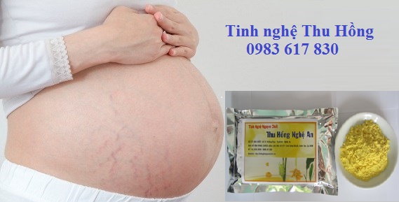 Mặt nạ nghệ giúp giảm các vết rạn da Mặt nạ nghệ giúp giảm các vết rạn da