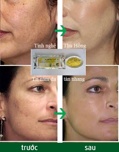 Trị tàn nhang hiệu quả bằng tinh nghệ vàng- tinh nghệ Thu Hồng Trị tàn nhang hiệu quả bằng tinh nghệ vàng- tinh nghệ Thu Hồng