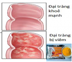 Điều trị ung thư đại trằng bằng tinh nghệ curumin Điều trị ung thư đại trằng bằng tinh nghệ curumin