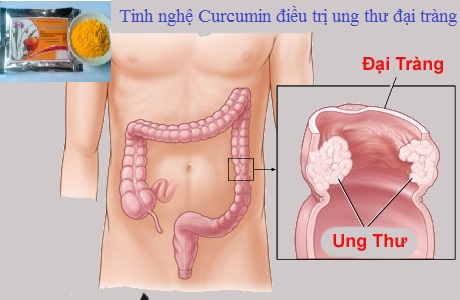 Tinh nghệ Curcumin giúp chữa ung thư đại tràng Tinh nghệ Curcumin giúp chữa ung thư đại tràng