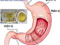 Đau dạ dày cấp tính