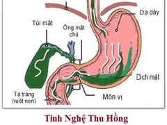 Loét dạ dày và cách chữa bệnh loét dạ dày hiệu quả
