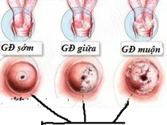 Tác dụng của tinh bột nghệ với căn bệnh xơ nang