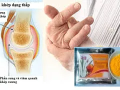 Tinh nghệ Curcumin niềm vui cho người bệnh viêm khớp