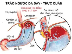 Trào ngược dạ dày nguyên nhân và cách chữa trị