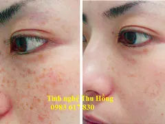Trị nám da tàn nhang HIỆU QUẢ với TINH CHẤT NGHỆ CURCUMIN