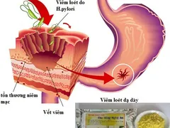 Triệu chứng của bệnh đau dạ dày