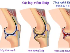 Viêm khớp dạng thấp