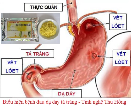 Bệnh đau dạ dày để lâu sẽ dẫn tới ung thư dạ dày Bệnh đau dạ dày để lâu sẽ dẫn tới ung thư dạ dày