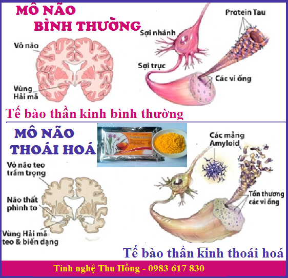 Uống tinh bột nghệ giúp bảo vệ não bộ