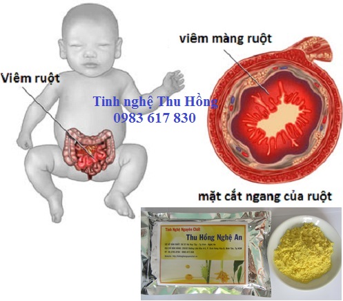 Chữa ung thư viêm ruột bằng tinh nghệ Curcumin Chữa ung thư viêm ruột bằng tinh nghệ Curcumin
