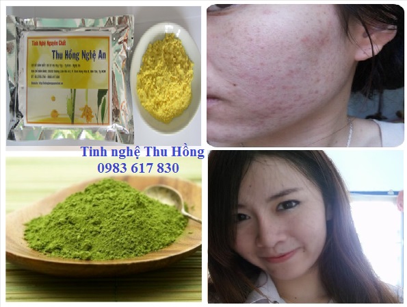 Sử dụng tinh bột nghệ trị mụn vô cùng hiệu quả Sử dụng tinh bột nghệ trị mụn vô cùng hiệu quả