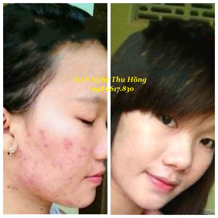 Khi gan bị quá tải dẫn đến thừa cân, nổi mụn...