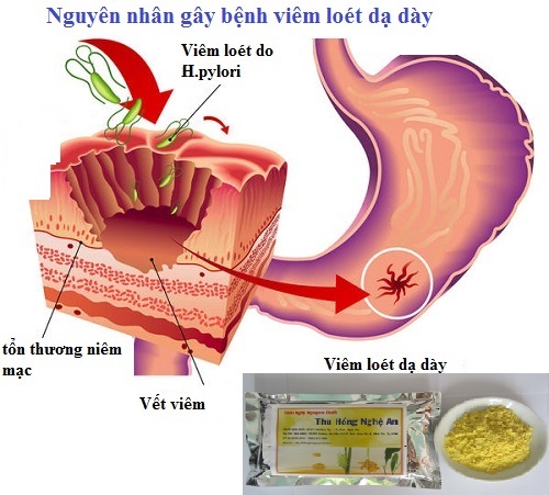 Nguyên nhân gây viêm loét dạ dày Nguyên nhân gây viêm loét dạ dày