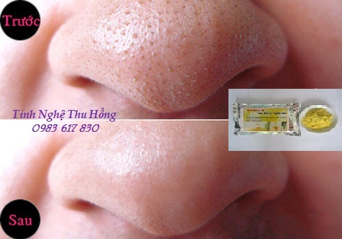 Mặt nạ nghệ giúp trị mụn trứng cá Mặt nạ nghệ giúp trị mụn trứng cá