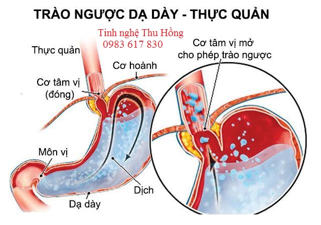 Bệnh trào ngược dạ dày Bệnh trào ngược dạ dày