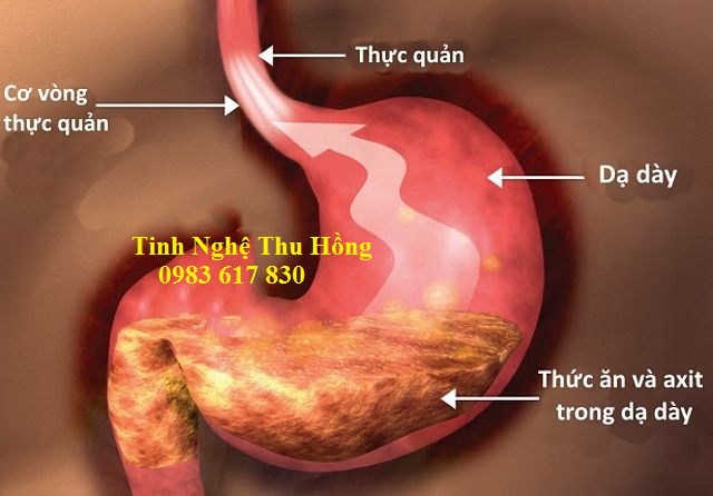 Tinh bột nghệ giúp cơ thể kháng lại ung thư dạ dày Tinh bột nghệ giúp cơ thể kháng lại ung thư dạ dày