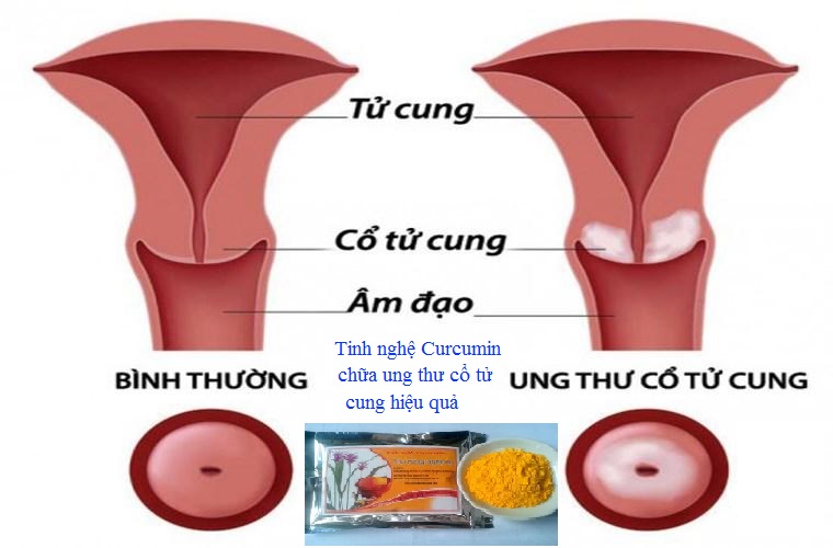 Curcumin là sản phẩm tuyệt vời trong việc chữa ung thư cổ tử cung Curcumin là sản phẩm tuyệt vời trong việc chữa ung thư cổ tử cung