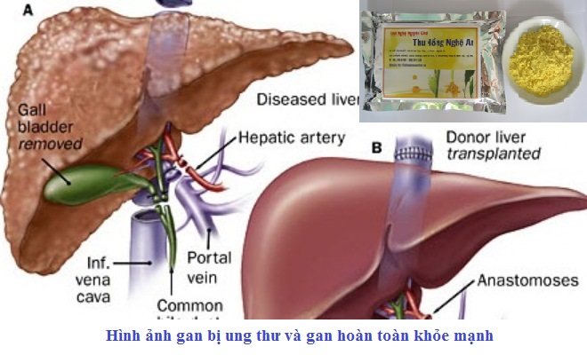 Công dụng của nghệ vàng Công dụng của nghệ vàng