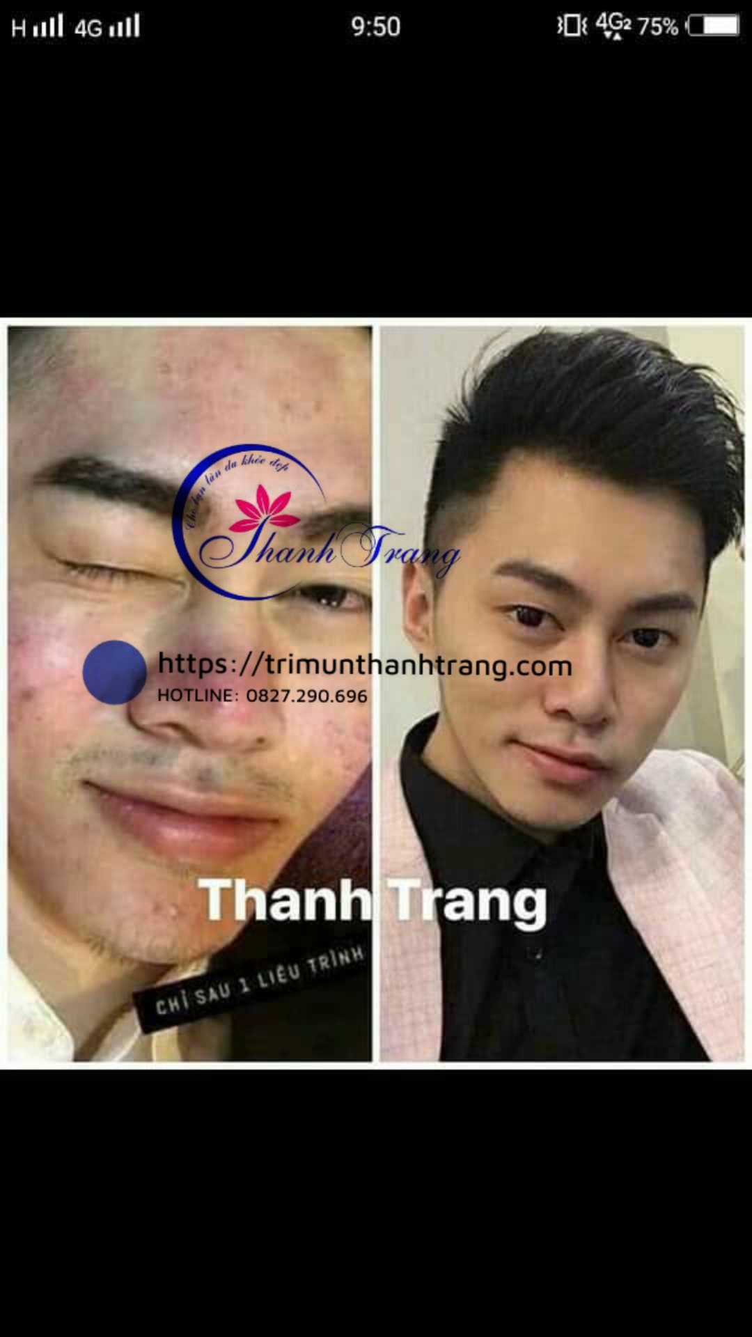Cách giúp da nhanh bong khi dùng tái tạo da Trị Mụn Thanh Trang
