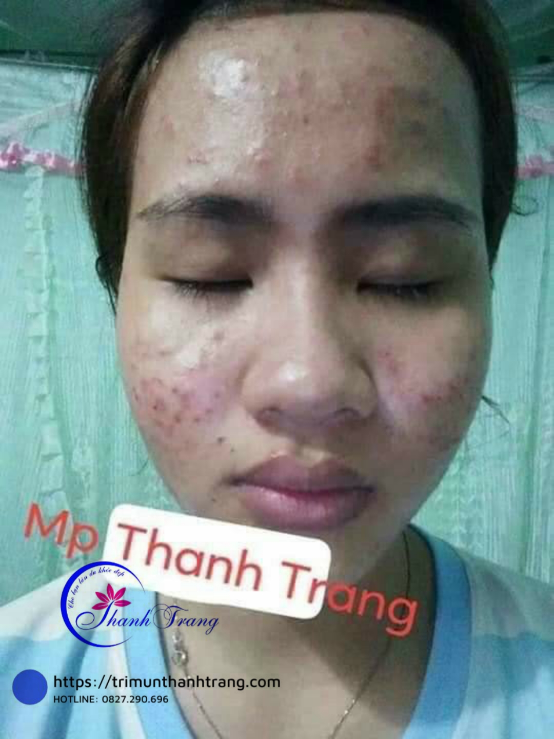 Cách giúp da nhanh bong khi dùng tái tạo da Trị Mụn Thanh Trang