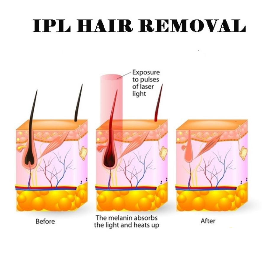 top 3 máy triệt lông hiệu quả 2024 top 3 máy triệt lông hiệu quả 2024