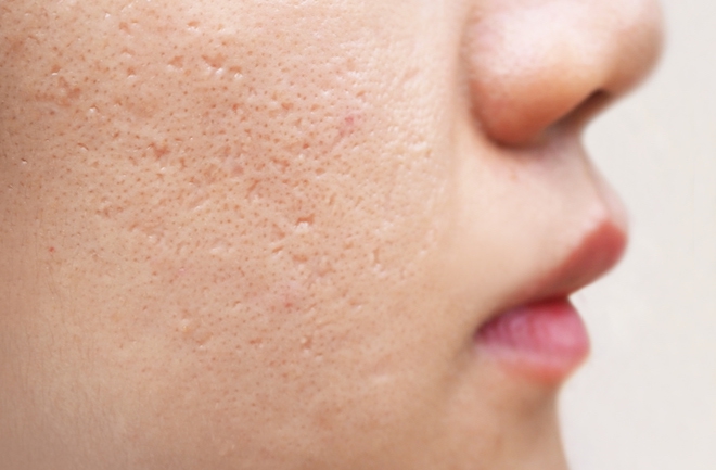 Điều trị sẹo rỗ bằng Máy laser CO2 Fotona Điều trị sẹo rỗ bằng Máy laser CO2 Fotona