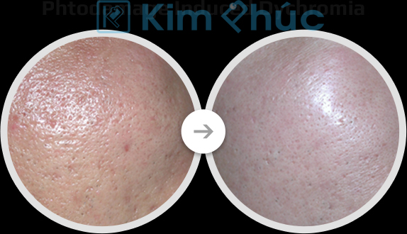 Máy Laser CO2 Fractional Trị Sẹo Rỗ Fire Xel Máy Laser CO2 Fractional Trị Sẹo Rỗ Fire Xel