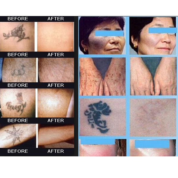 Máy Laser Q Switched ND YAG SANHE Máy Laser Q Switched ND YAG SANHE