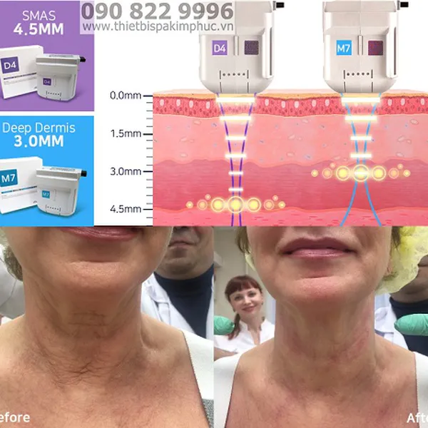 Máy HIFU Nâng Cơ HIRONIC