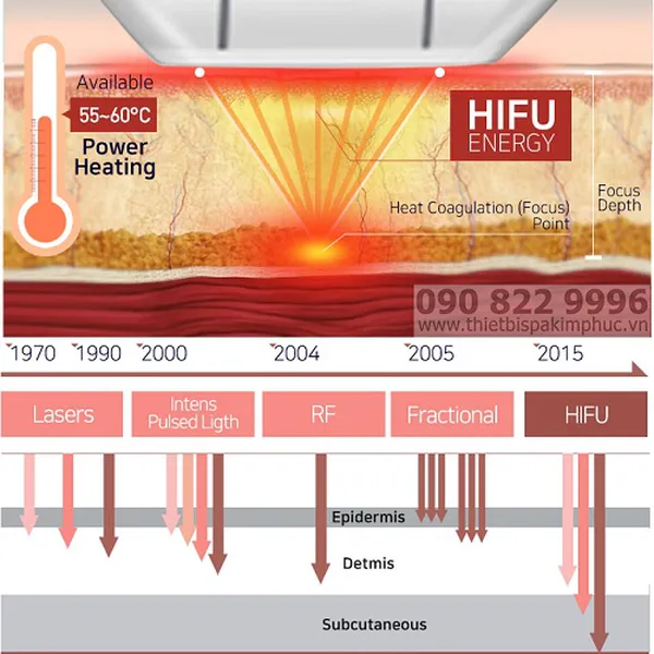 Máy HIFU Nâng Cơ HIRONIC