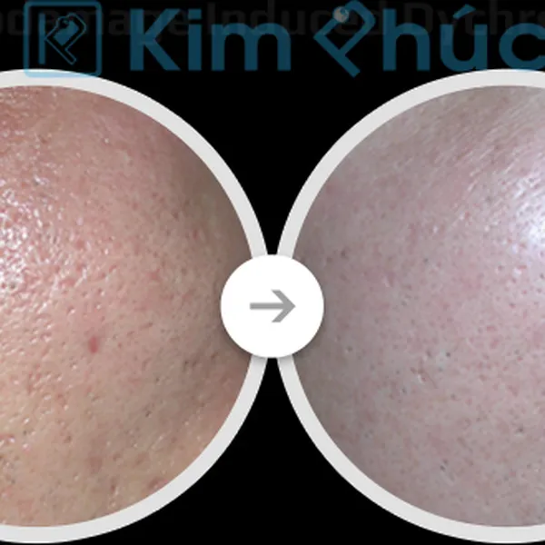 Máy Laser CO2 Fractional Trị Sẹo Rỗ Fire Xel Korea