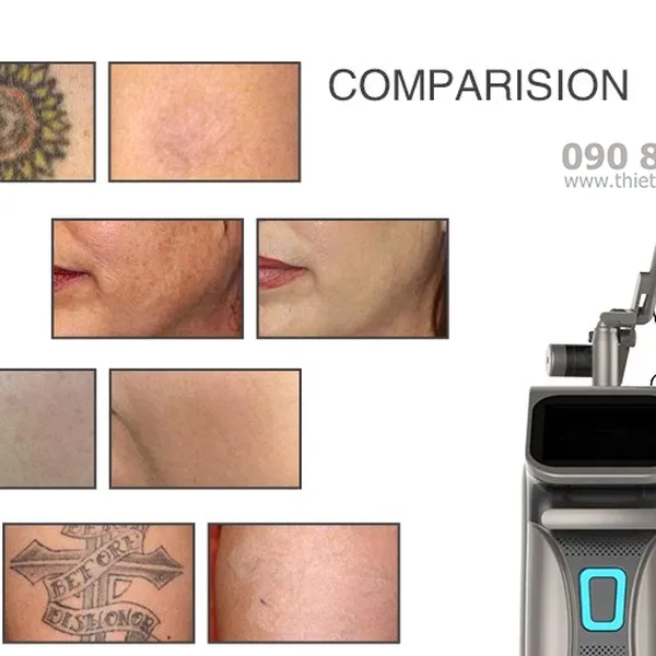 Máy Laser Picosecond Q-Switched ND