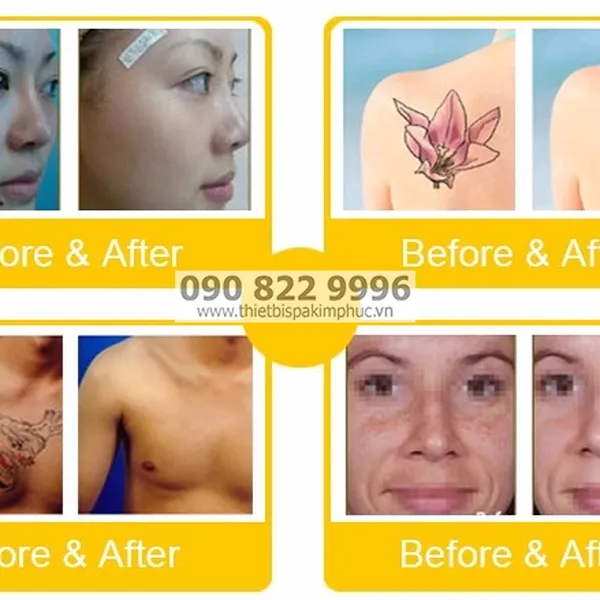 Máy Laser Picosecond Q-Switched ND