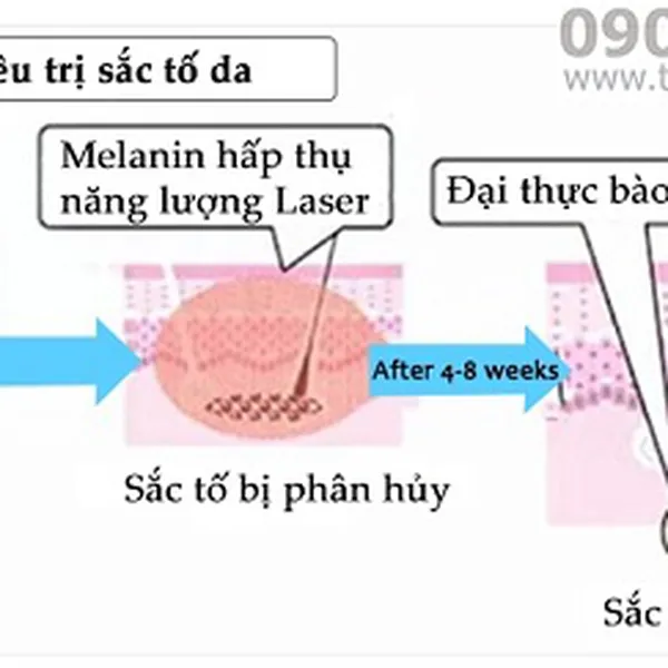 Máy Laser Xóa Xăm Picosecond