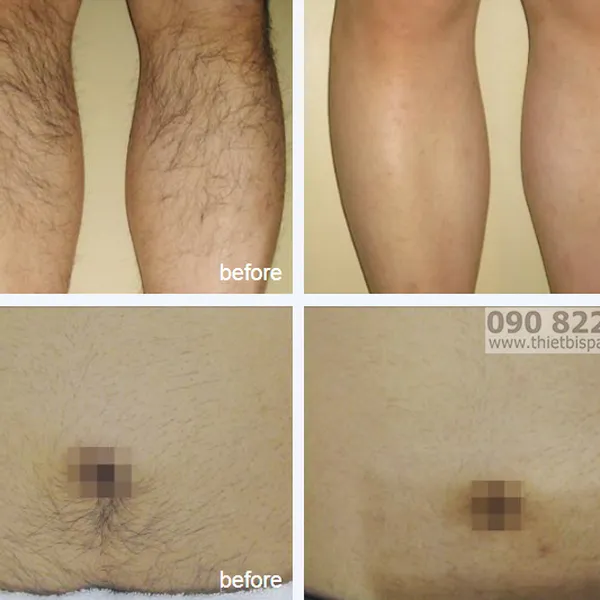 Máy Triệt Lông Diode Laser Aroma Korea
