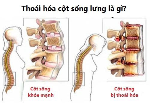 Thoái hóa cột sống lưng là gì?