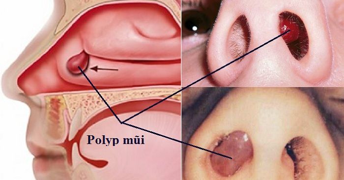 Biện pháp điều trị bệnh Polyp mũi