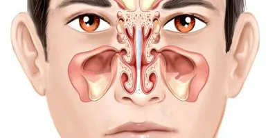 Làm Sao Để Đẩy Lùi Viêm Xoang Khi Thời Tiết Thay Đổi?