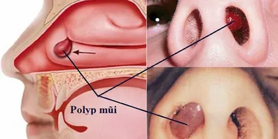 Bệnh Polyp mũi là gì? Nguyên nhân và cách điều trị