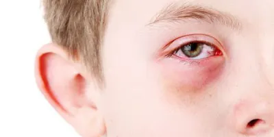 Những điều cần biết về bệnh đau mắt đỏ