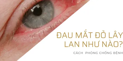 Đau mắt đỏ lây lan như nào và cách phòng bệnh